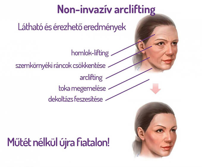 HIFU arckezelés hatásai