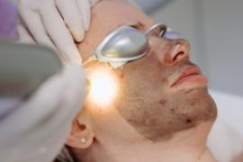 CarbonPeel Prémium kezelés 