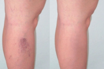 A varikózis eltávolítása a lábakon lézeres következményekkel, Visszértágulat: lézeres kezelés