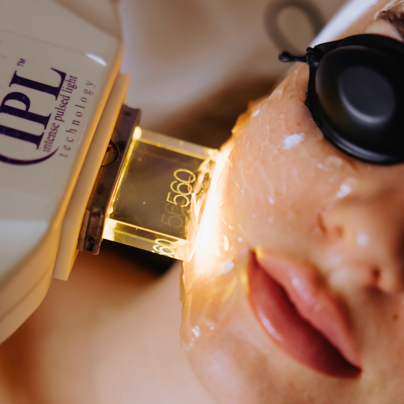 Photorejuvenációs érkezelés a Bársonyban