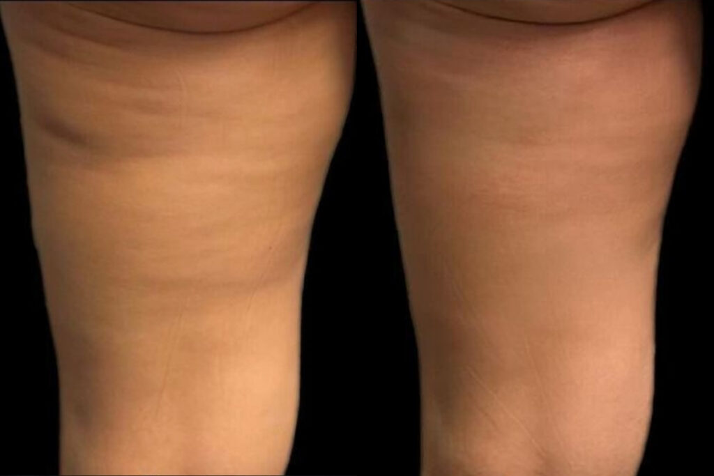 Bőrfeszesítés VIVACE 2.0 Virtue RF kezeléssel