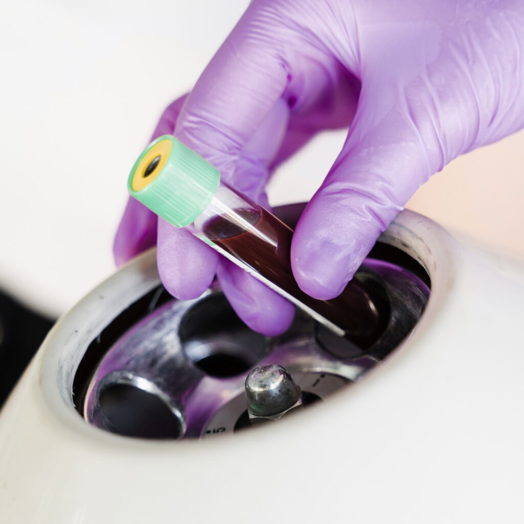 Drakula terápia PRP kezelés Bársony